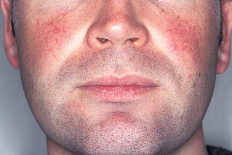 Sử dụng sản phẩm chăm sóc da mặt kém chất lượng hoặc quá lạm dụng mỹ phẩm có thể dẫn đến tình trạng nổi mẩn đỏ trên da mặt 