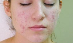Viêm nang lông ở mặt là hiện tượng nang lông ở da mặt bị các vi khuẩn, nấm xâm nhập và tấn công