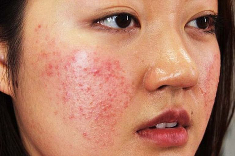 Vùng da bị dị ứng đỏ, nổi sẩn kèm theo triệu chứng khác như nóng rát và khó chịu
