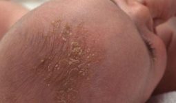 Viêm da tiết bã da đầu hay còn gọi là “cứt trâu” là bệnh thường gặp ở trẻ sơ sinh