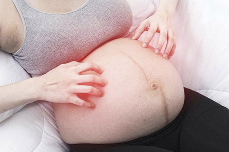 Bị mề đay lúc mang bầu ảnh hưởng tới sức khỏe thai nhi