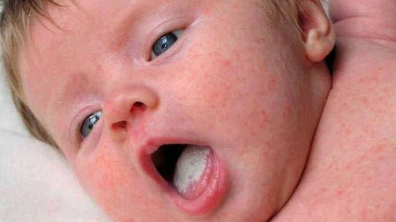 Có rất nhiều nguyên nhân khiến trẻ bị nấm lưỡi ngày từ khi còn sơ sinh