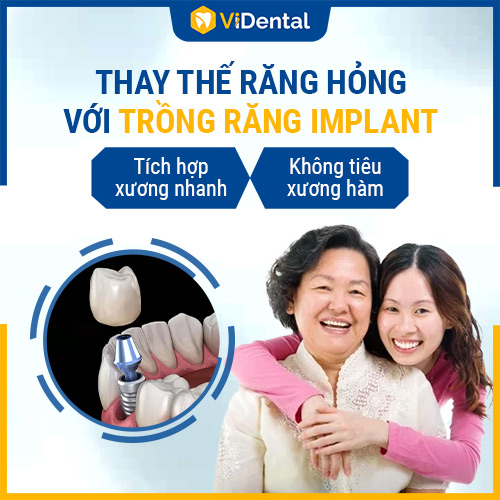Trồng răng Implant là phương pháp chỉnh nha bền vững, đẹp tự nhiên được nhiều người lựa chọn