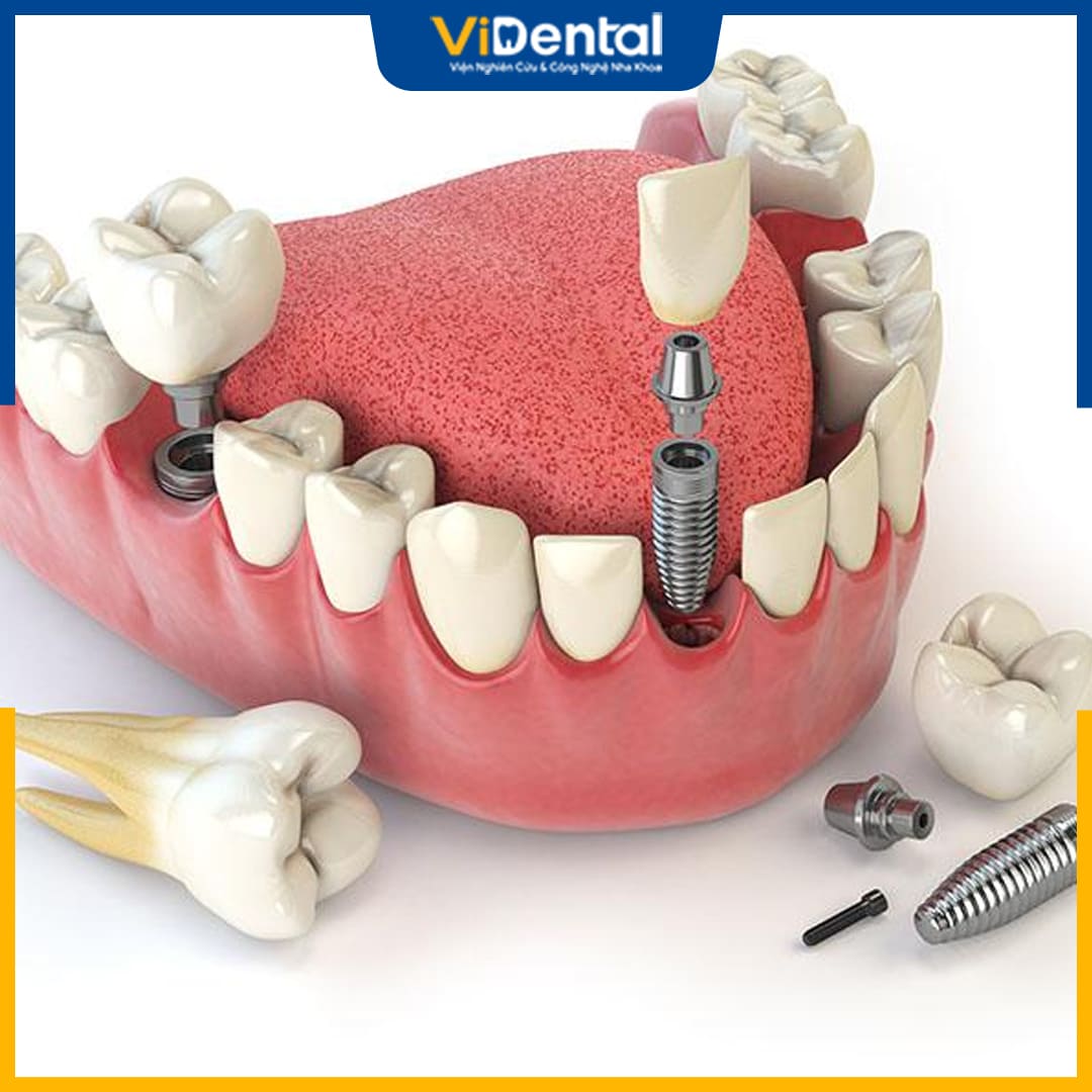 Cấy ghép Implant là phương pháp trồng răng sứ thẩm mỹ cao cấp và hiện đại nhất hiện nay