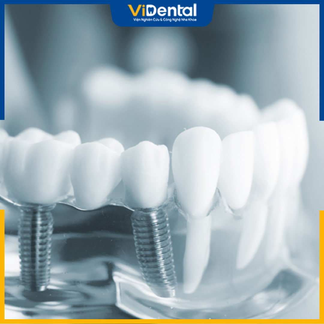 Trồng răng sứ là phương pháp nha khoa thẩm mỹ hiện đại, nhiều người lựa chọn