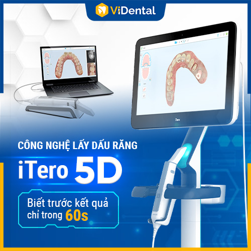 Ứng dụng công nghệ quét dấu răng iTero 5D hiện đại, chính xác
