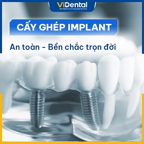 Cấy ghép răng implant là giải pháp chỉnh nha an tòan, bền vững