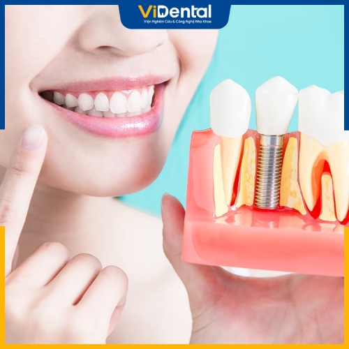 Trồng răng implant là phương pháp cấy trụ kim loại vào xương hàm để thay thế cho răng đã mất