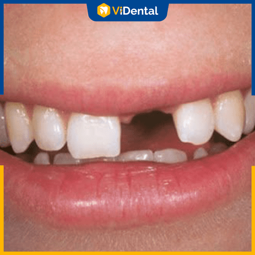 Trồng răng implant có thể áp dụng trong hầu hết các trường hợp mất răng, chỉ cần bạn có một sức khỏe tốt