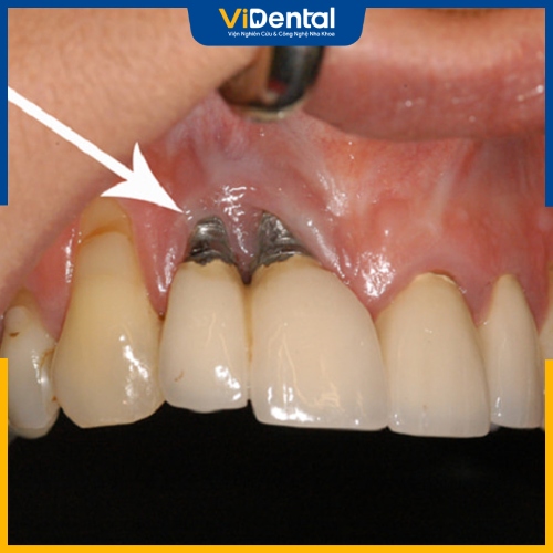 Trụ implant bị đào thải là một trong những biến chứng nguy hiểm khi trồng răng implant sai cách