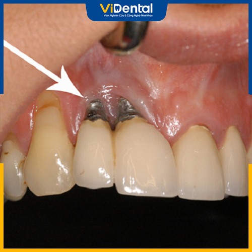 Để trồng răng implant giá rẻ, các đơn vị thường sử dụng trụ không chất lượng