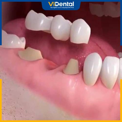 Cầu răng sứ là giải pháp khôi phục một hoặc nhiều răng mất cố định phổ biến hiện nay