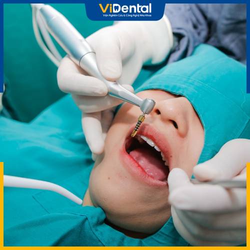 Cấy ghép implant là phương pháp phục hồi răng mất hiệu quả và an toàn nhất hiện nay