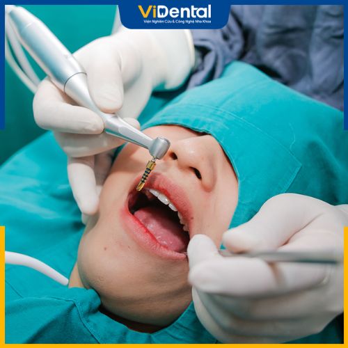 Đặt trụ implant là bước quan trọng nhất trong toàn bộ quá trình cấy răng implant