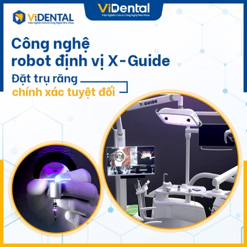 Vidental áp dụng robot X-Guide vào quy trình trồng răng implant