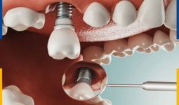 Trồng Răng Implant Có Nguy Hiểm Không? Quy Trình Trồng Răng Như Thế Nào?
