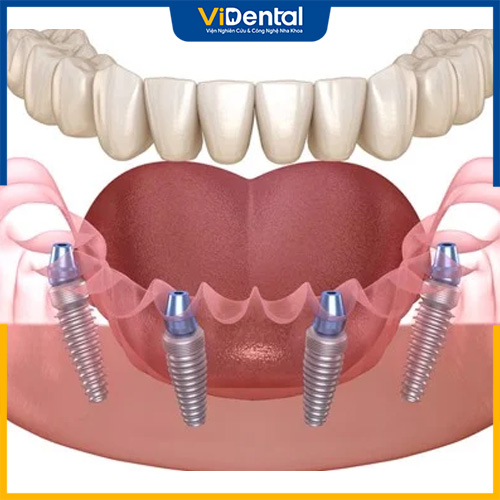 Trồng răng implant là phương pháp làm răng giả nguyên hàm tối ưu nhất hiện nay