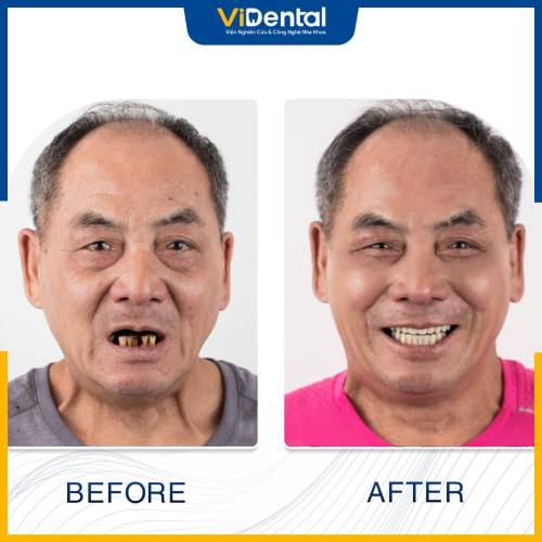 Hình ảnh chú Sơn trước và sau khi trồng răng Implant tại Vidental