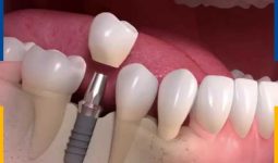 Trồng Răng Implant Mất Bao Lâu? Cần Lưu Ý Gì Sau Khi Thực Hiện?