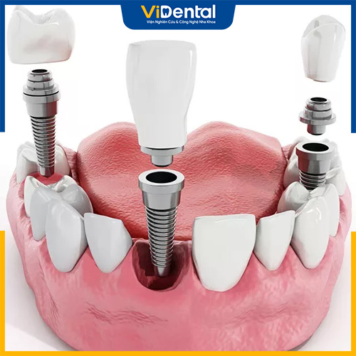 Trồng răng implant trả góp mang lại nhiều lợi ích cho khách hàng
