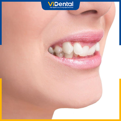 Trồng răng khểnh là phương pháp giúp nhanh chóng có nụ cười duyên