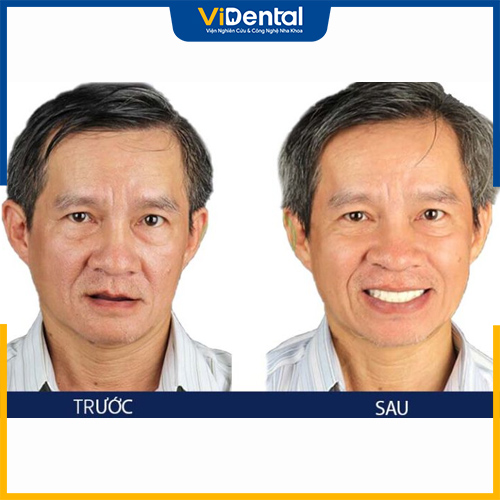 Hình ảnh chú Sơn trước và sau khi trồng răng Implant