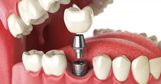 Trồng răng giả là gì? Chi phí 3 phương pháp trồng răng giả | Dr. Care