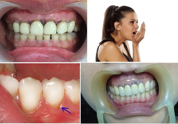 Nha sĩ cảnh báo 5 biến chứng khi bọc răng sứ kém chất lượng