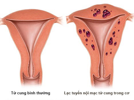 Lạc tuyến nội mạc tử cung trong cơ tử cung (bệnh cơ tuyến tử cung)