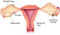 Triệu chứng, cách chẩn đoán lạc nội mạc tử cung | Vinmec