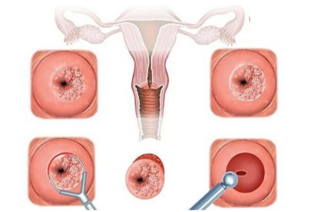 Viêm cổ tử cung: Nguyên nhân và triệu chứng cảnh báo | Vinmec