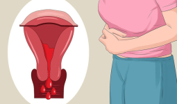 Phân loại và giai đoạn lạc nội mạc tử cung | Vinmec
