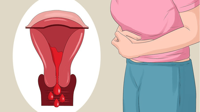 Phân loại và giai đoạn lạc nội mạc tử cung | Vinmec