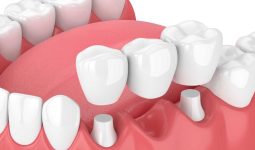 Nên trồng răng bằng cầu răng hay cấy ghép implant | Vinmec