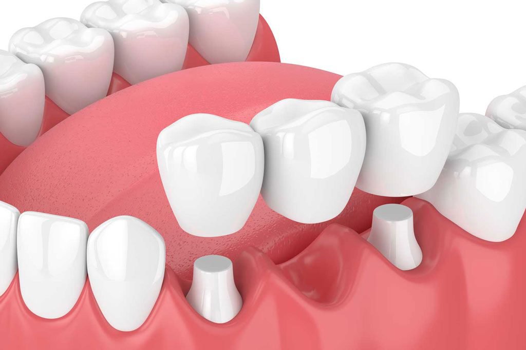 Nên trồng răng bằng cầu răng hay cấy ghép implant | Vinmec