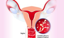 Nếu bị viêm âm đạo do nấm Candida, chị em phụ nữ cần phải làm gì? | Medlatec