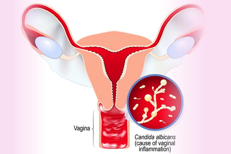 Nếu bị viêm âm đạo do nấm Candida, chị em phụ nữ cần phải làm gì? | Medlatec