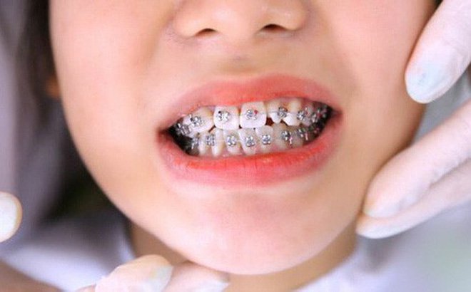 Niềng răng có mấy giai đoạn? | Vinmec