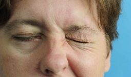 Bệnh liệt bell gây mất thẩm mỹ cho gương mặt bệnh nhân