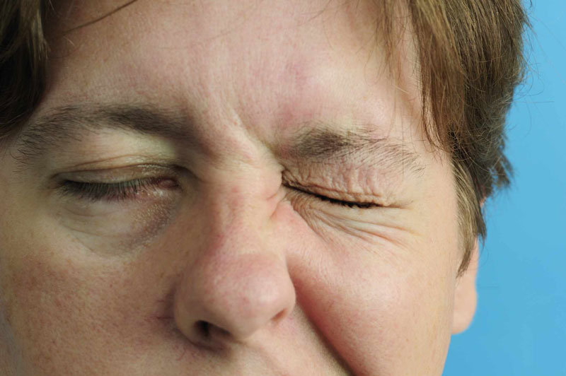 Khi mắc bệnh liệt nửa mặt, thị lực của bệnh nhân suy giảm rõ rệt