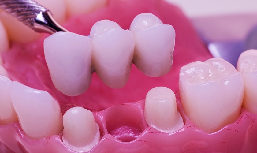 Có nên thực hiện làm cầu răng sứ cho người bị mất răng không?