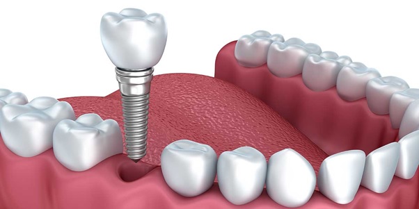 15+ [Kinh nghiệm] trồng răng Implant, bảng giá cấy ghép Implant