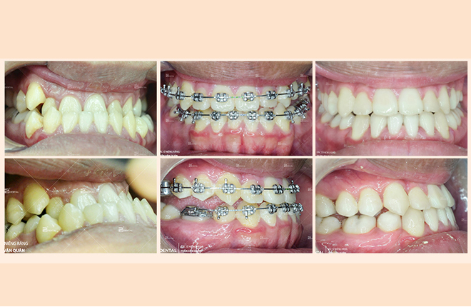 sự thay đổi của răng móm khi niềng răng mắc cài kim loại