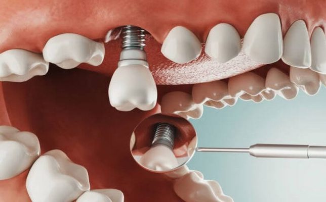 Trồng răng implant miễn phí