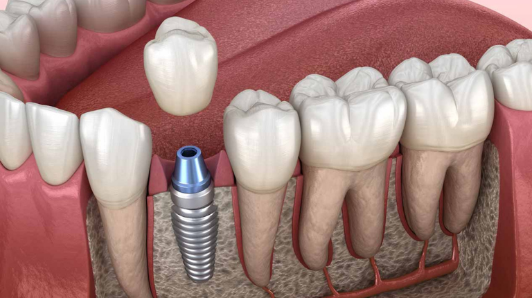 Quy Trình Cấy Ghép Implant - LN Dental Chester Hill