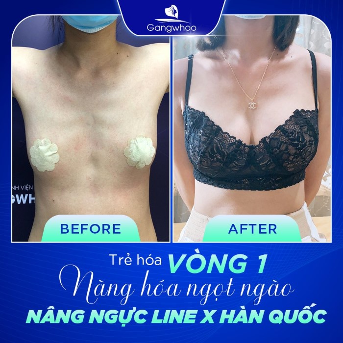 Khách hàng trải nghiệm nâng ngực tại Thẩm mỹ viện Gangwhoo 