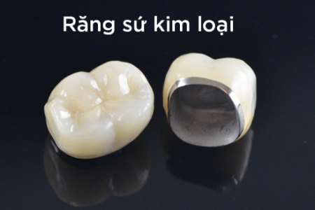 Hiện nay có những loại răng sứ thẩm mỹ nào? Nên chọn loại nào cho vùng răng  cửa - nhakhoathuyanh