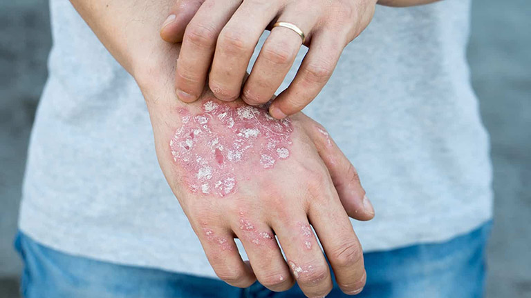 Bệnh Chàm Eczema: Nguyên Nhân, Dấu Hiệu Và Cách Xử Lý An Toàn