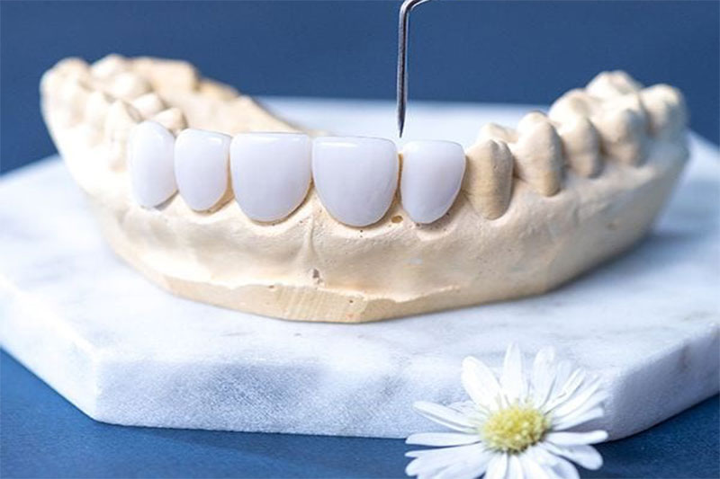 Bọc răng sứ Emax là gì? Giá bao nhiêu tiền?
