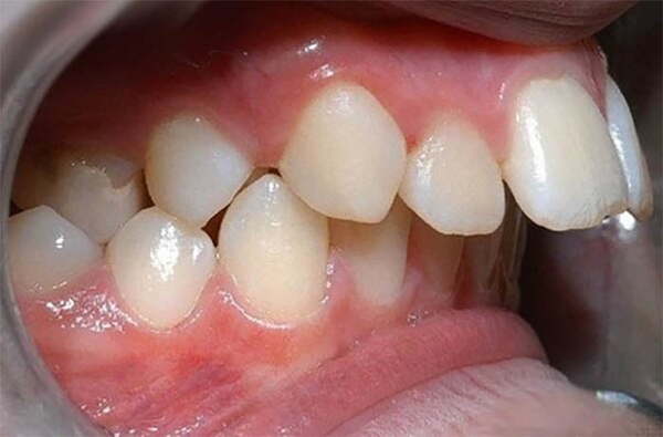 Phương pháp bọc sứ có phù hợp với răng hô hay không?